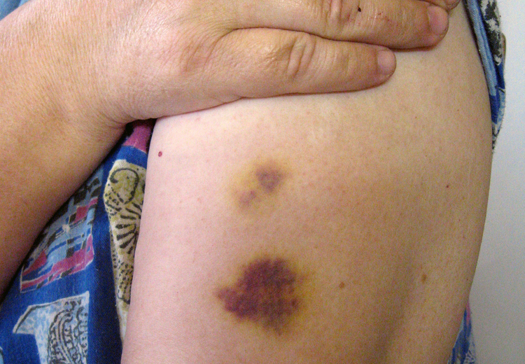 abuse bruise harrassment