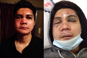 Actor-Host Vhong Navarro badly beaten up by Cedric Lee and his group.