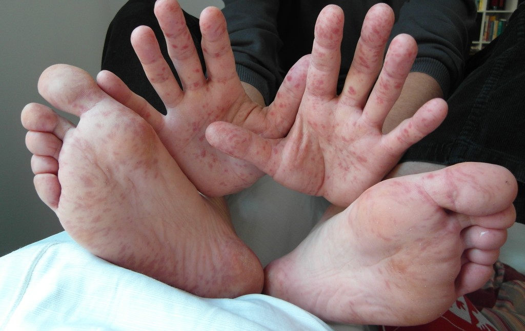 Hand, foot, and mouth disease (Wikipedia photo)