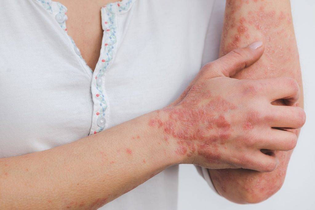 psoriasis skin disease