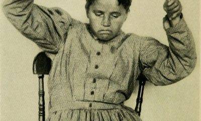 A woman with catatonia ‘posturing’.