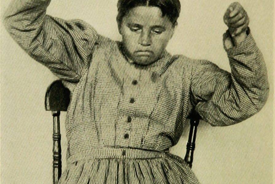 A woman with catatonia ‘posturing’.