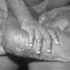 close up of monkeypox on a child