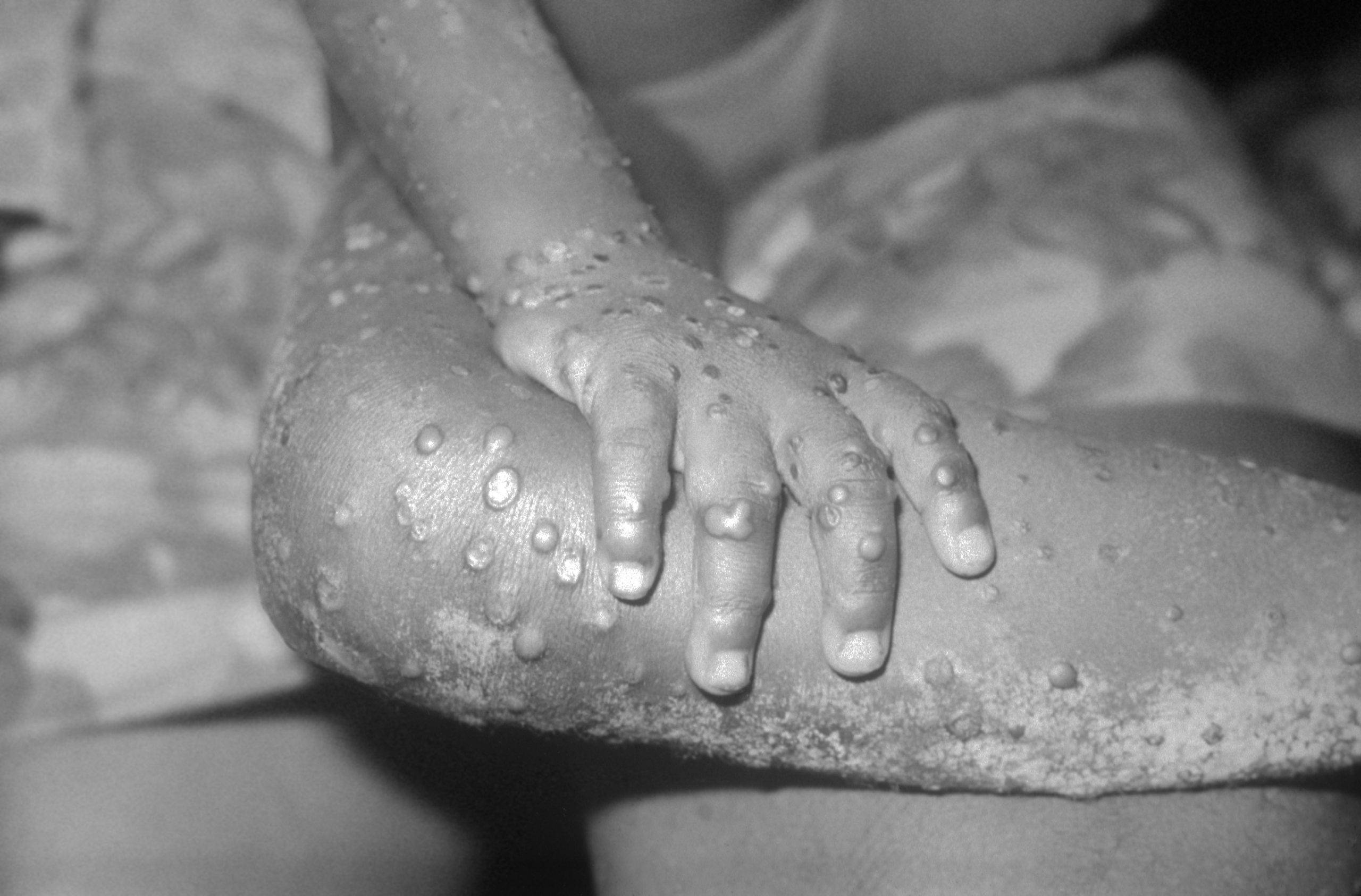 What Is Monkeypox? A Microbiologist Explains What's Known About This Disease