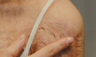 Grafted skin