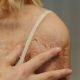 Grafted skin