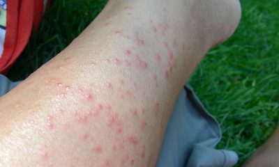 skin rash on leg