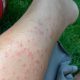 skin rash on leg