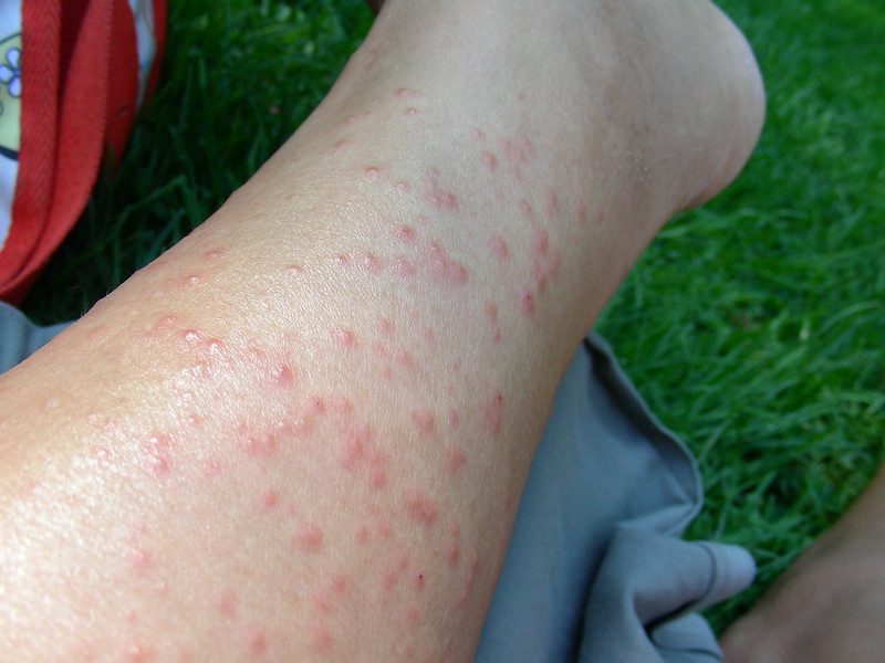 skin rash on leg