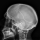 X-ray_of_deep_brain_stimulation